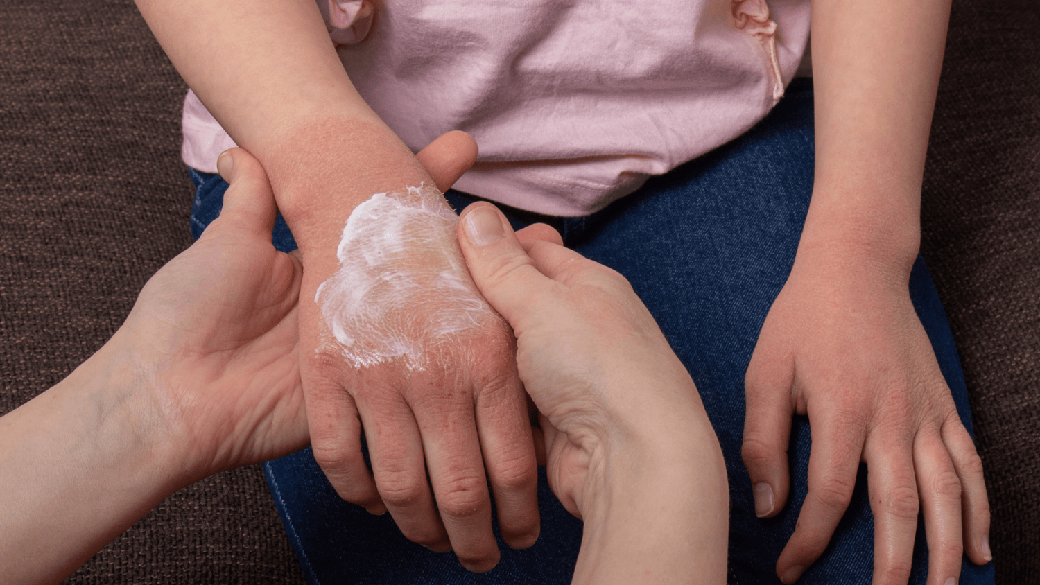 Steroid Creams for Eczema: Risks and Nature’s Alternatives - ALittlePeace