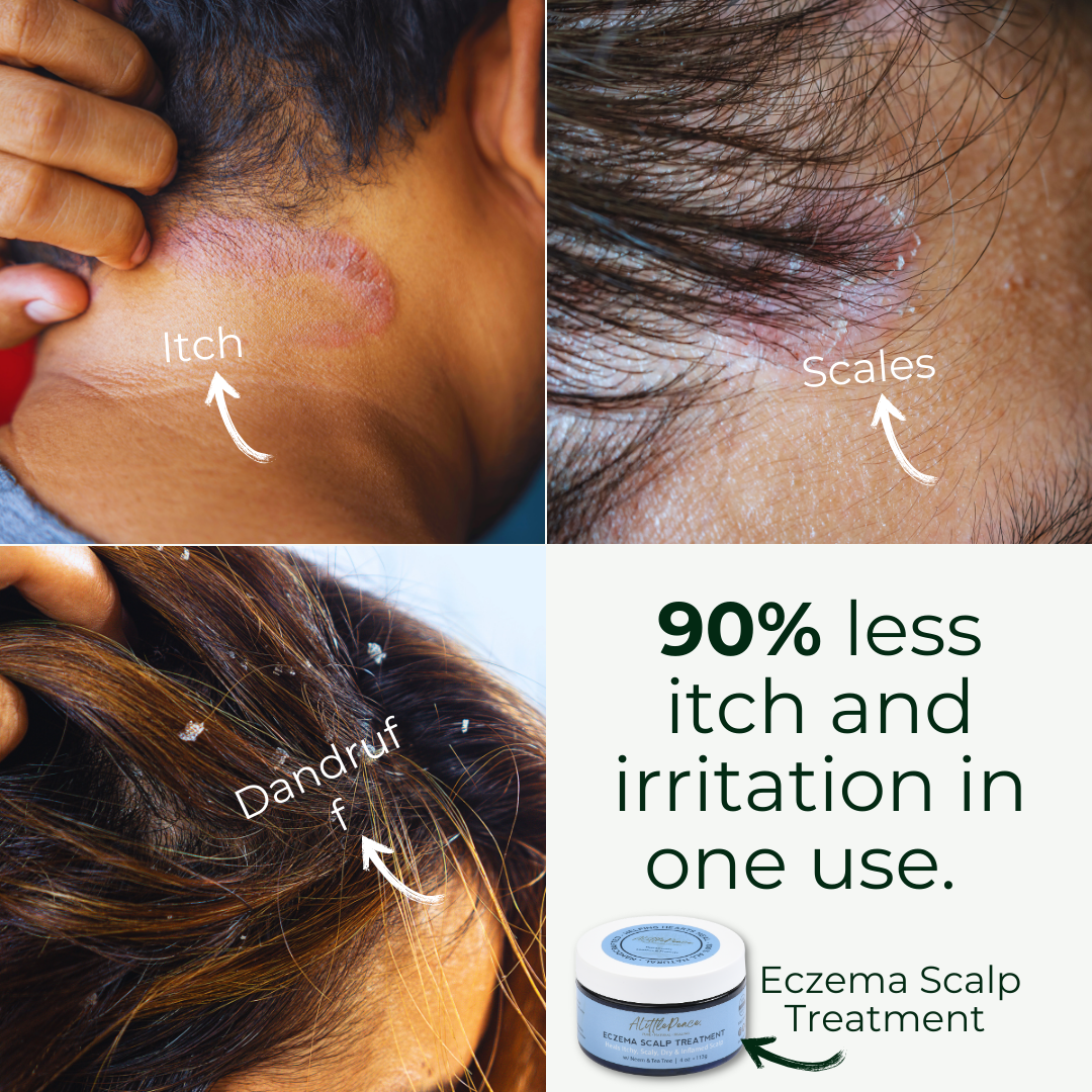 Eczema Scalp Treatment w/Tea Tree &amp; Neem