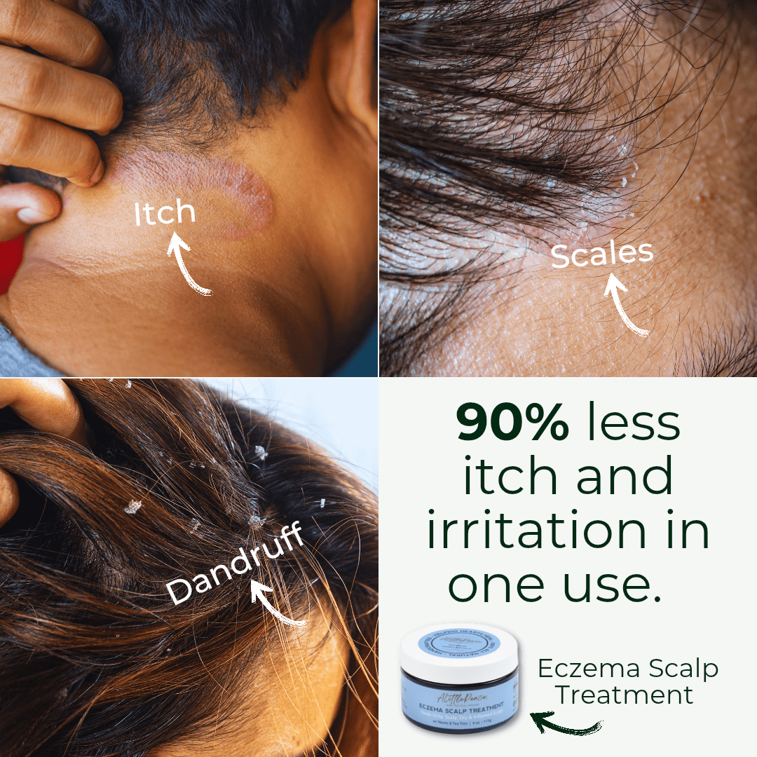 Eczema Scalp Treatment w/Tea Tree & Neem – ALittlePeace