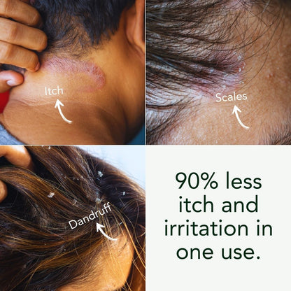 Eczema Scalp Treatment w/Tea Tree & Neem