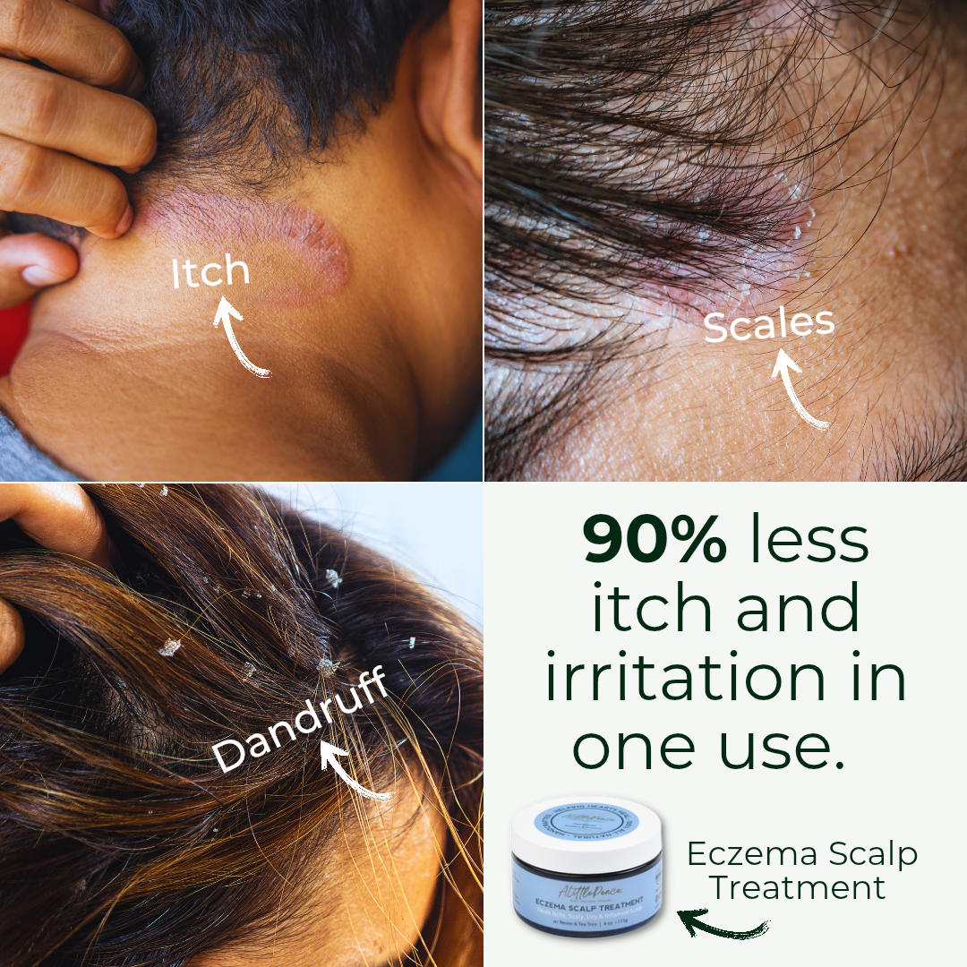 Eczema Scalp Treatment w/Tea Tree & Neem