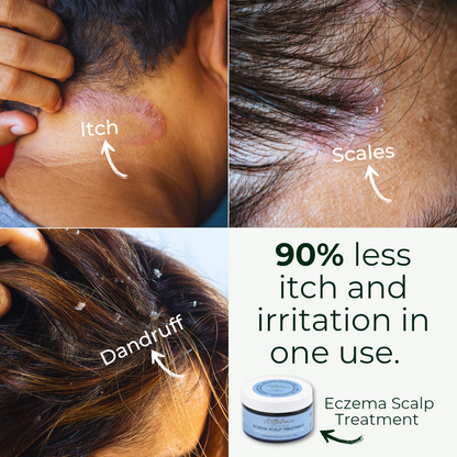 Eczema Scalp Treatment w/Tea Tree &amp; Neem